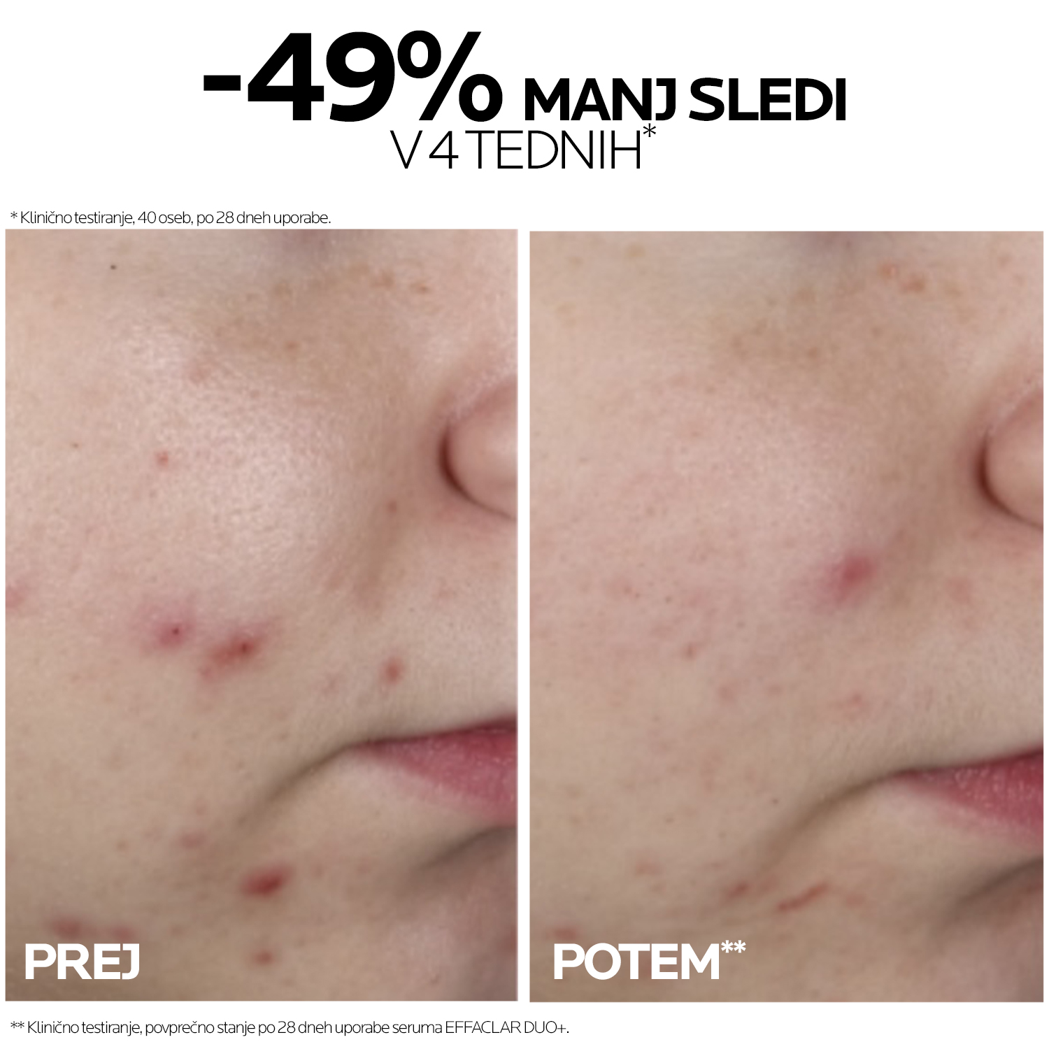 Effaclar Ultra koncentrirani serum za aknasto kožo – La Roche-Posay, 30 ml