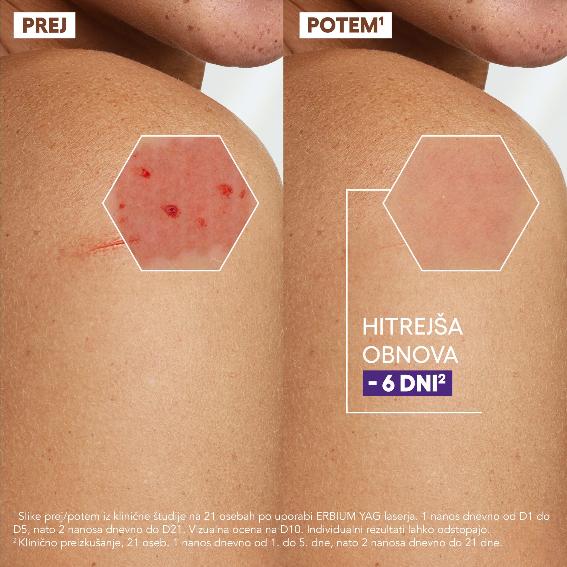 A-Derma Epithelial Ultra Repair obnavljajoča krema proti sledem, 40 ml