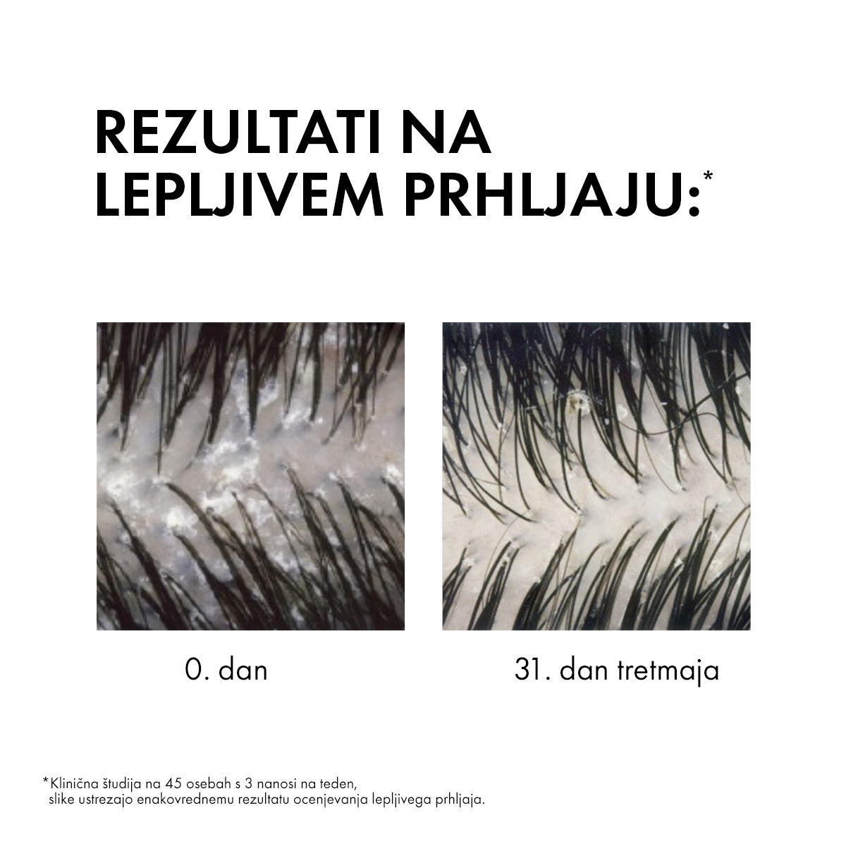 Vichy Dercos šampon proti prhljaju za normalne in mastne lase, 390 ml refill